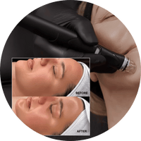 HydraFacial Treatments